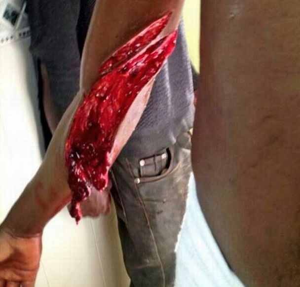 Imagen del desgarro causado por las 'concertinas' en el brazo de uno de los inmigrantes que consiguió atravesar el martes la frontera en Melilla. / @augc_melilla