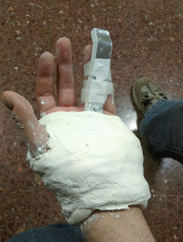 Aspecto de la mano de Jesús Rodríguez. / twitter @Reflex_volucion